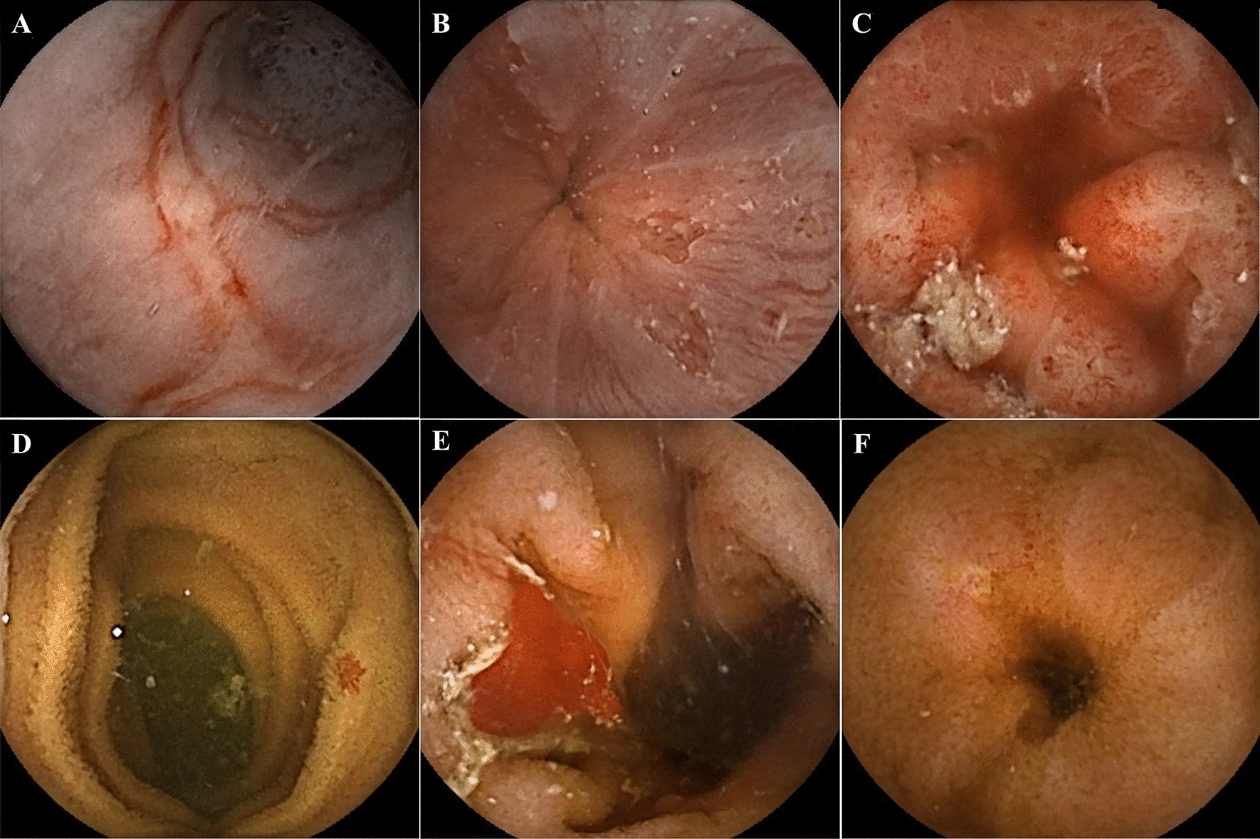 VCE images showing various small bowel sections